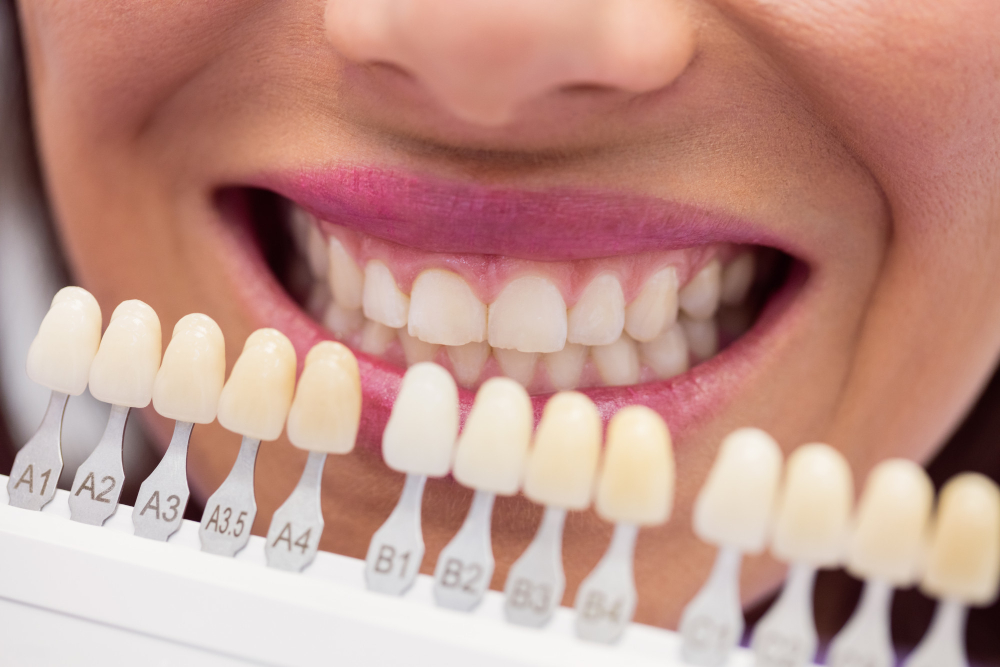Facetas de porcelana em Ipaussu: quando esse tratamento é indicado para o seu caso