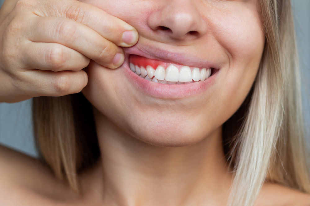 Gengivoplastia em Ipaussu: agende sua avaliação e conquiste um sorriso mais harmônico